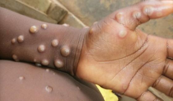 Brasil registra 140 casos de mpox em 2026; mais de 500 ainda estão em investigação
