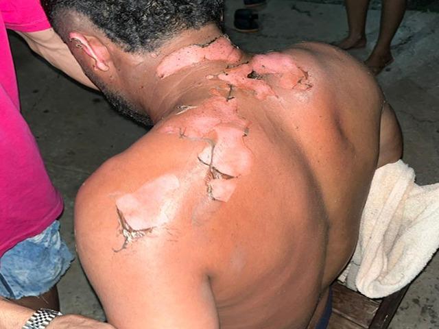 Mulher pôs fogo no marido após eles brigarem por término de relacionamento